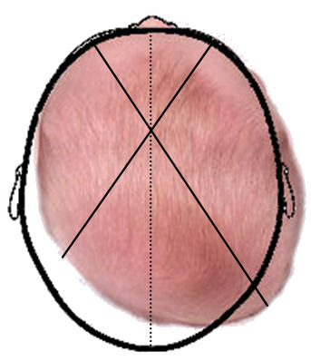 plagiocefalia e osteopatia